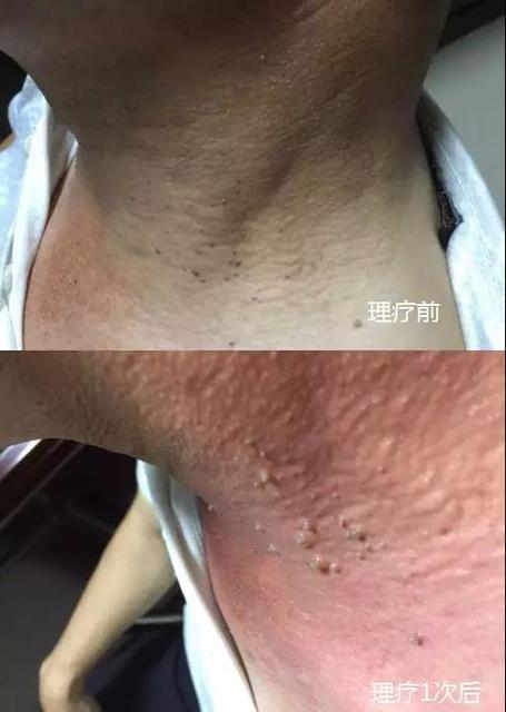 杨先生,脖子处长了小小颗粒状深色肉痣(变异细胞),使用绿韵细胞理疗