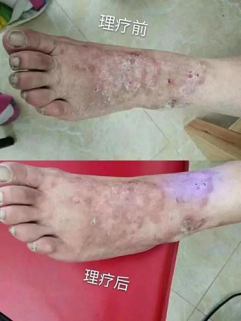 皮肤病类案例(全)